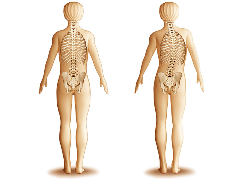 Spinal Deformities