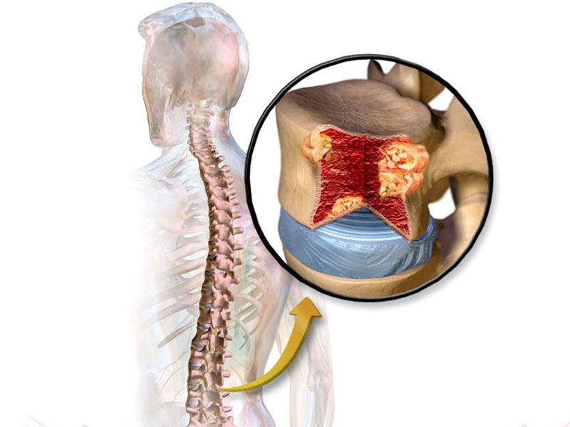 Spinal Tumors