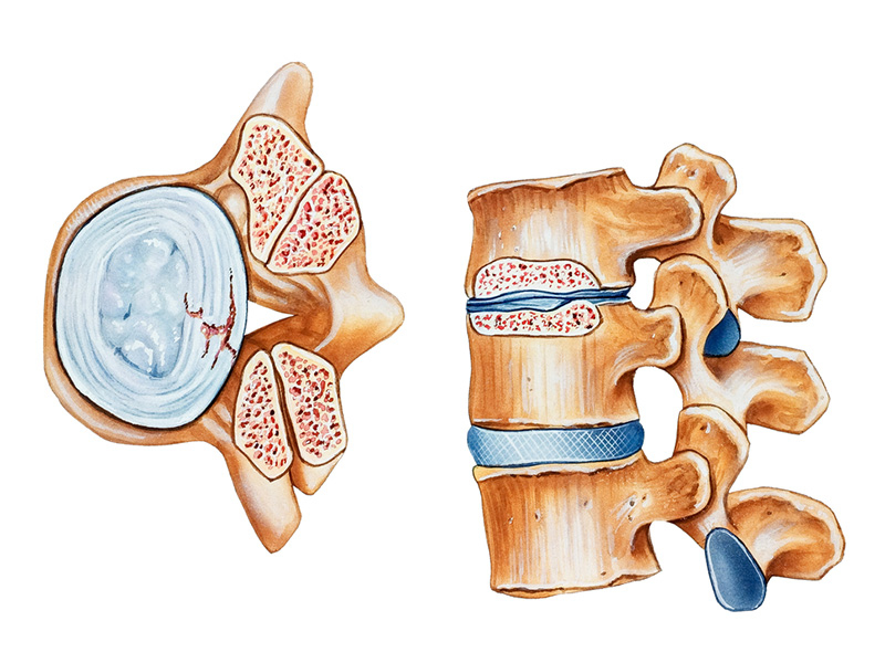 Spinal Tumors